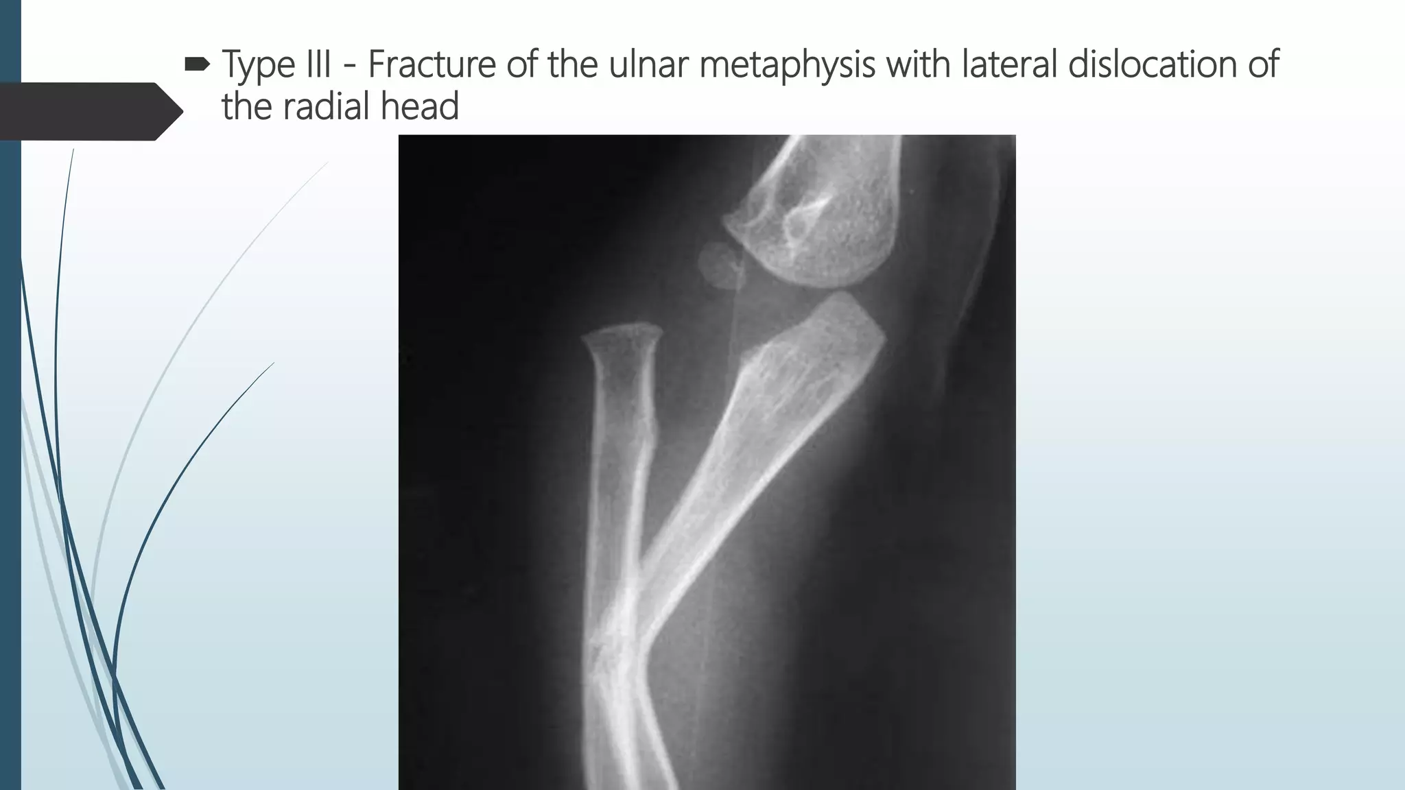 Fractures of radius and ulna . | PPTX