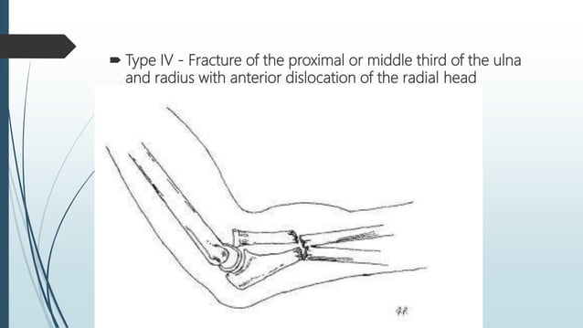 Fractures of radius and ulna . | PPTX | Death, Injury, or Military ...