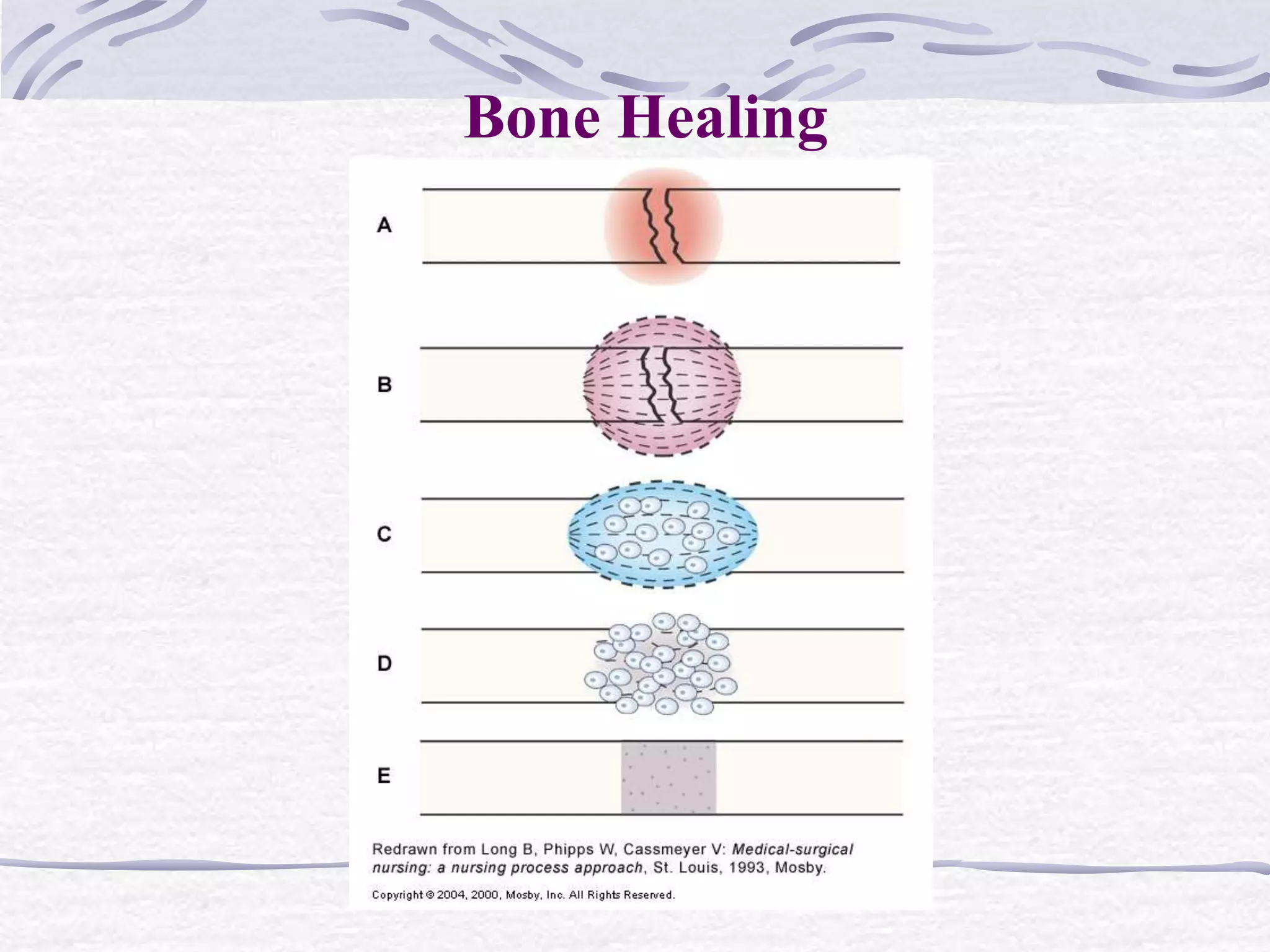 Bone Healing
 