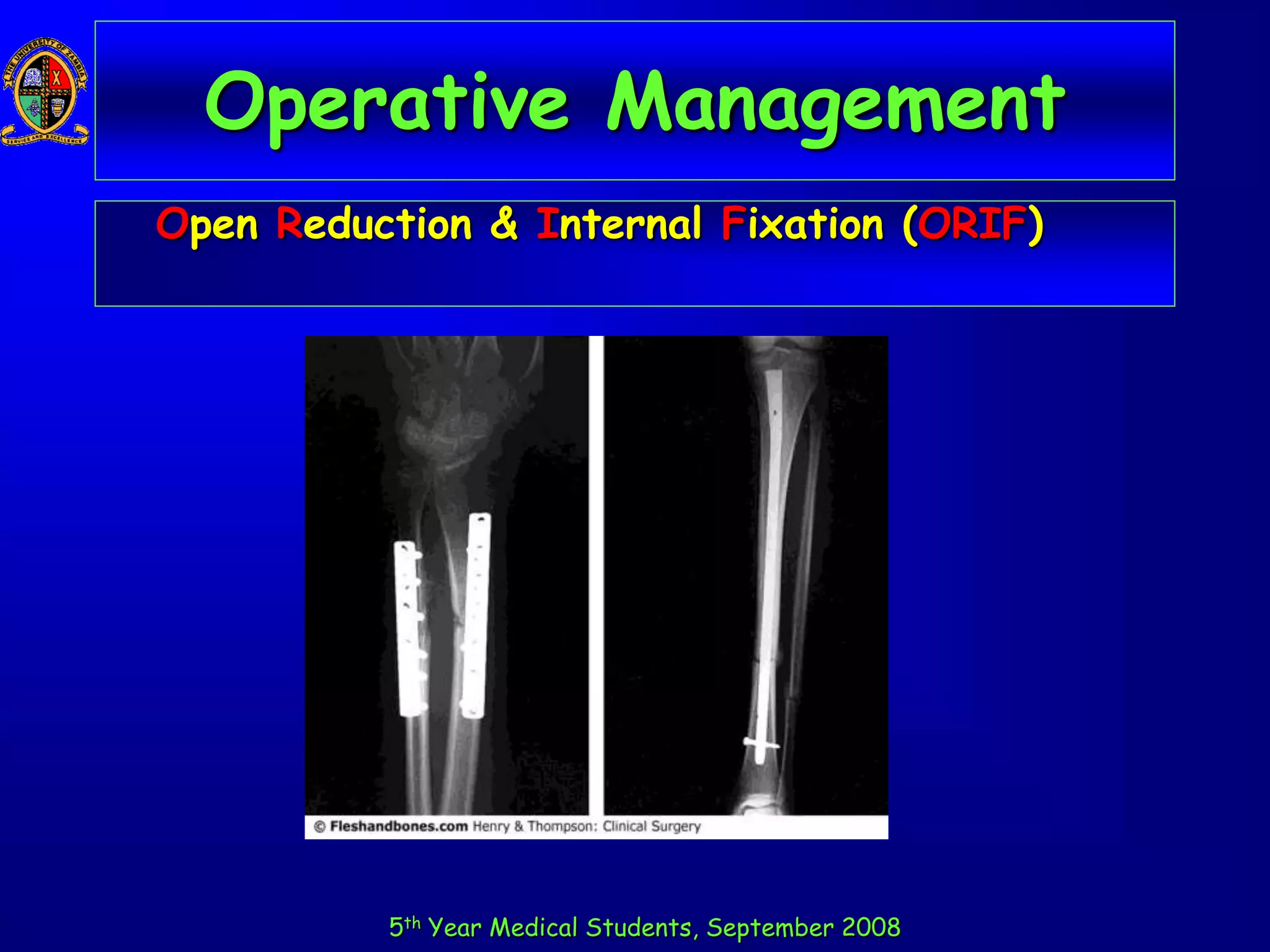 Fractures.ppt
