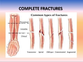 fRACTURES.pptx