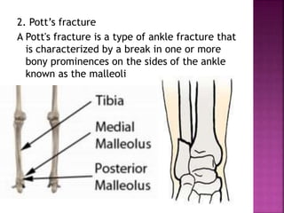 Pottys Fructure FRACTURES NOTES PREPAIRED BY NATUNGA RONALD | PPTX