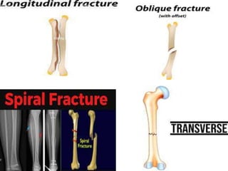 power point presentation fractures note | PPTX