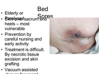 Bed
Sores
• Elderly or
Paralysed
• Skin over sacrum and
heels – most
vulnerable
• Prevention by
careful nursing and
early activity
• Treatment is difficult.
By necrotic tissue
excision and skin
grafting
• Vacuum assisted
 