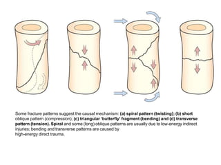 Some fracture patterns suggest the causal mechanism: (a) spiral pattern (twisting); (b) short
oblique pattern (compression); (c) triangular ‘butterfly’ fragment (bending) and (d) transverse
pattern (tension). Spiral and some (long) oblique patterns are usually due to low-energy indirect
injuries; bending and transverse patterns are caused by
high-energy direct trauma.
 