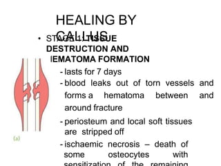 HEALING BY
CALLUS
• STAGE 1: TISSUE
DESTRUCTION AND
HEMATOMA FORMATION
- lasts for 7 days
- blood leaks out of torn vessels and
forms a hematoma between and
around fracture
- periosteum and local soft tissues
are stripped off
- ischaemic necrosis – death of
some osteocytes with
 