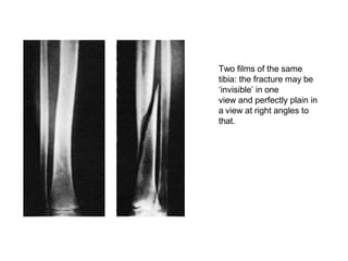 Two films of the same
tibia: the fracture may be
‘invisible’ in one
view and perfectly plain in
a view at right angles to
that.
 