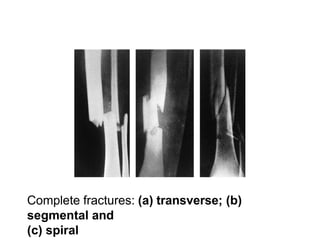 Complete fractures: (a) transverse; (b)
segmental and
(c) spiral
 