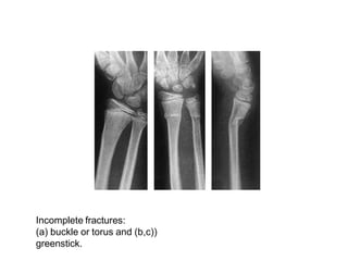 Incomplete fractures:
(a) buckle or torus and (b,c))
greenstick.
 