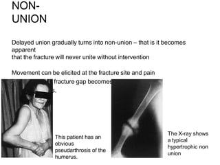 NON-
UNION
Delayed union gradually turns into non-union – that is it becomes
apparent
that the fracture will never unite without intervention
Movement can be elicited at the fracture site and pain
diminishes; the fracture gap becomes a type of
pseudoarthrosis.
This patient has an
obvious
pseudarthrosis of the
humerus.
The X-ray shows
a typical
hypertrophic non
union
 