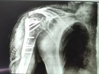 FRACTURES in human body fractures medicine.pptx