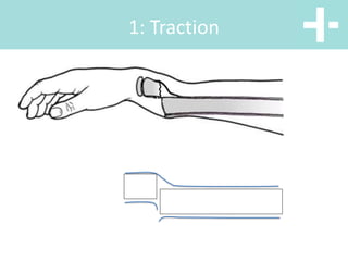 Distal Traction Rotation Distal Radius and Wrist Fractures | PPTX