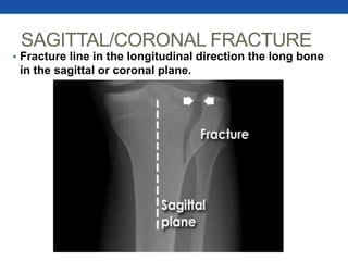 SAGITTAL/CORONAL FRACTURE
• Fracture line in the longitudinal direction the long bone
in the sagittal or coronal plane.
 