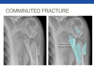 COMMINUTED FRACTURE
 