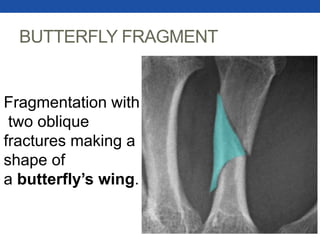 BUTTERFLY FRAGMENT
Fragmentation with
two oblique
fractures making a
shape of
a butterfly’s wing.
 