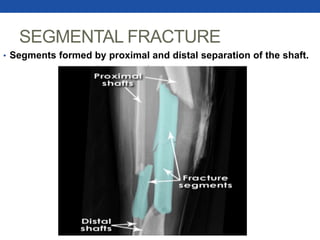 SEGMENTAL FRACTURE
• Segments formed by proximal and distal separation of the shaft.
 