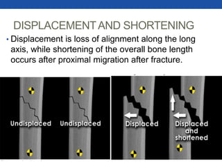 DISPLACEMENTAND SHORTENING
• Displacement is loss of alignment along the long
axis, while shortening of the overall bone length
occurs after proximal migration after fracture.
 