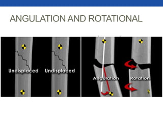 ANGULATION AND ROTATIONAL
 