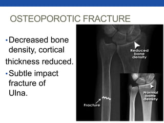 OSTEOPOROTIC FRACTURE
•Decreased bone
density, cortical
thickness reduced.
•Subtle impact
fracture of
Ulna.
 