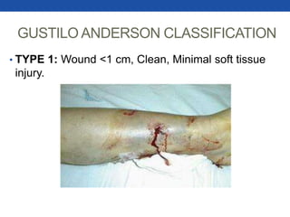 GUSTILO ANDERSON CLASSIFICATION
• TYPE 1: Wound <1 cm, Clean, Minimal soft tissue
injury.
 