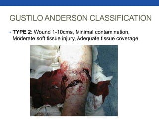 GUSTILO ANDERSON CLASSIFICATION
• TYPE 2: Wound 1-10cms, Minimal contamination,
Moderate soft tissue injury, Adequate tissue coverage.
 