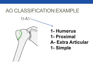 AO CLASSIFICATION:EXAMPLE
1- Humerus
1- Proximal
A- Extra Articular
1- Simple
 