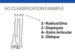AO CLASSIFICATION:EXAMPLE
2- Radius/Ulna
2- Diaphysis
A- Extra Articular
2- Oblique
 