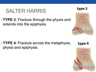 SALTER HARRIS
• TYPE 3: Fracture through the physis and
extends into the epiphysis.
• TYPE 4: Fracture across the metaphysis,
physis and epiphysis.
 