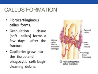 CALLUS FORMATION
• Fibrocartilaginous
callus forms.
• Granulation tissue
(soft callus) forms a
few days after the
fracture.
• Capillaries grow into
the tissue and
phagocytic cells begin
cleaning debris.
 