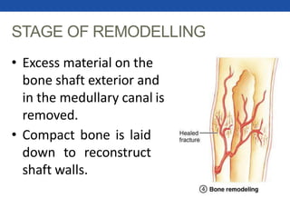 STAGE OF REMODELLING
• Excess material on the
bone shaft exterior and
in the medullary canal is
removed.
• Compact bone is laid
down to reconstruct
shaft walls.
 