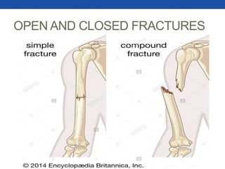 OPEN AND CLOSED FRACTURES
 
