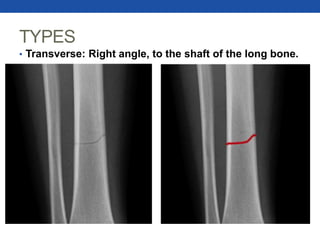 TYPES
• Transverse: Right angle, to the shaft of the long bone.
 
