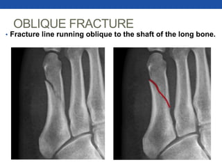OBLIQUE FRACTURE
• Fracture line running oblique to the shaft of the long bone.
 