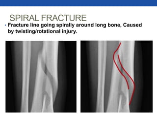 SPIRAL FRACTURE
• Fracture line going spirally around long bone, Caused
by twisting/rotational injury.
 