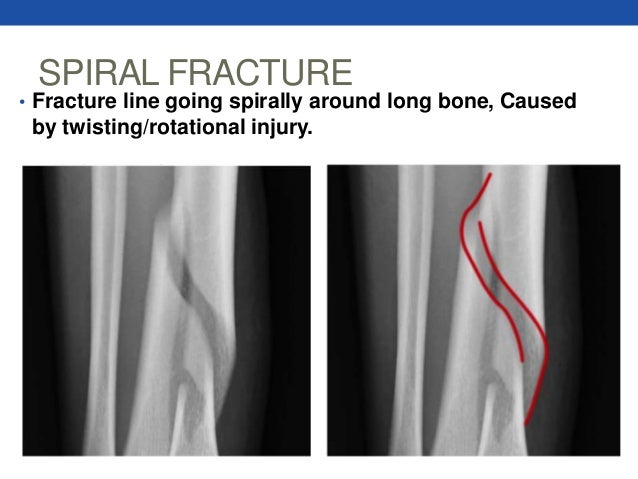 spiral fracture causes spiral fracture causes