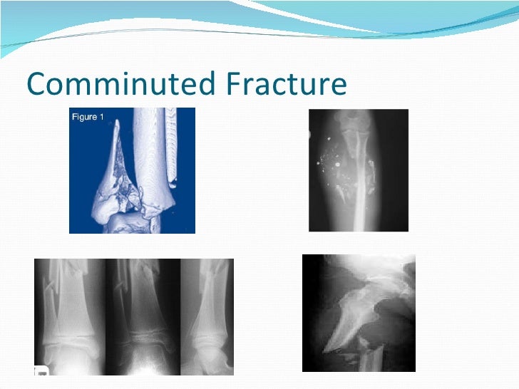 Fractures Presentation For Chapter 4