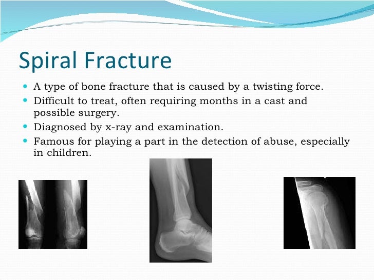 spiral fracture causes spiral fracture causes