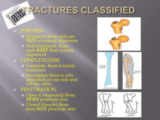    POSITION
       Displaced-Bone ends are
        OUT of normal alignment
       Non-Displaced- Bone
        ends KEEP their normal
        alignment
   COMPLETENESS
       Complete- Bone is totally
        separated
       Incomplete-Bone is only
        separated on one side and
        not the other
   PENETRATION
       Open (Compound)-Bone
        DOES penetrate skin
       Closed (Simple)-Bone
        does NOT penetrate skin
 