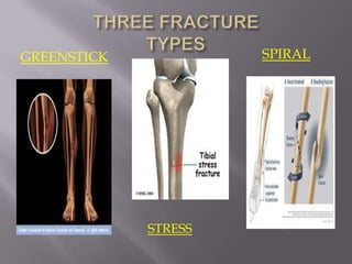 GREENSTICK            SPIRAL




             STRESS
 