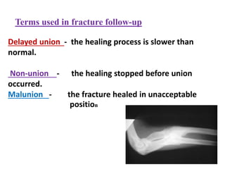 Fractures - general view | PPTX
