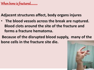 Fractures - general view | PPTX