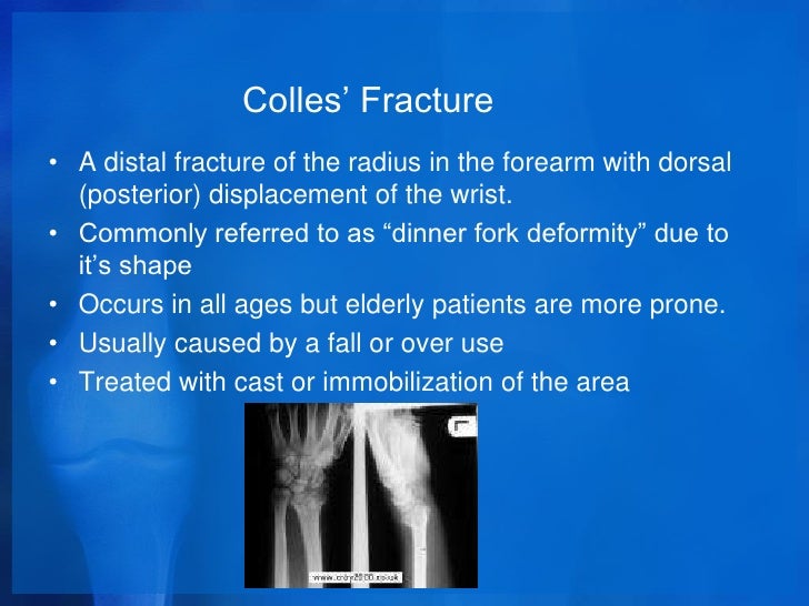 colles fracture healing time colles fracture healing time