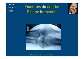 COUDE
GARCHES   Fractures du coude:
  2007
           Palette humérale




             DIU main & membre supérieur - DESC
 