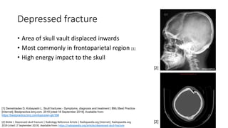 Depressed fracture
• Area of skull vault displaced inwards
• Most commonly in frontoparietal region [1]
• High energy impact to the skull
[1] Demetriades D, Kobayashi L. Skull fractures - Symptoms, diagnosis and treatment | BMJ Best Practice
[Internet]. Bestpractice.bmj.com. 2019 [cited 16 September 2019]. Available from:
https://bestpractice.bmj.com/topics/en-gb/398
[2] Bickle I. Depressed skull fracture | Radiology Reference Article | Radiopaedia.org [Internet]. Radiopaedia.org.
2019 [cited 17 September 2019]. Available from: https://radiopaedia.org/articles/depressed-skull-fracture
[2]
[2]
 