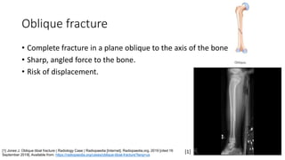Oblique fracture
• Complete fracture in a plane oblique to the axis of the bone
• Sharp, angled force to the bone.
• Risk of displacement.
[1] Jones J. Oblique tibial fracture | Radiology Case | Radiopaedia [Internet]. Radiopaedia.org. 2019 [cited 16
September 2019]. Available from: https://radiopaedia.org/cases/oblique-tibial-fracture?lang=us
[1]
 