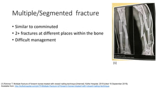 Multiple/Segmented fracture
• Similar to comminuted
• 2+ fractures at different places within the bone
• Difficult management
[1] Rohmer T. Multiple fracture of forearm bones treated with closed nailing technique [Internet]. Kolhe Hospital. 2019 [cited 16 September 2019].
Available from: http://kolhehospital.com/ph/?f=Multiple+fracture+of+forearm+bones+treated+with+closed+nailing+technique
[1]
 