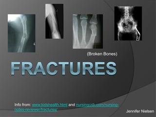 (Broken Bones)




Info from: www.kidshealth.html and nursingcrib.com/nursing-
notes-reviewer/fractures/                                     Jennifer Nielsen
 