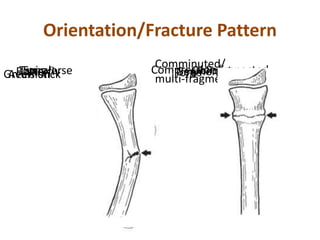 Orientation/Fracture Pattern
Transverse ObliqueButterfly SegmentalSpiral
Comminuted/
multi-fragmentaryAvulsion Compression/impactedGreen-stick Torus
 