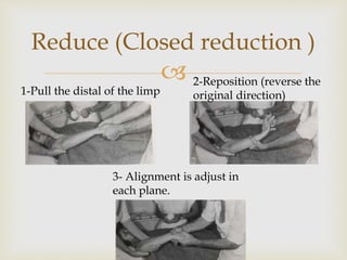 
Reduce (Closed reduction )
1-Pull the distal of the limp
2-Reposition (reverse the
original direction)
3- Alignment is adjust in
each plane.
 