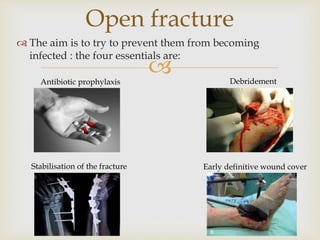 
 The aim is to try to prevent them from becoming
infected : the four essentials are:
Open fracture
Early definitive wound coverStabilisation of the fracture
DebridementAntibiotic prophylaxis
 